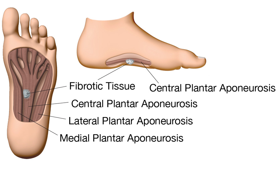 Illustration of Plantar Fibromatosis